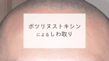 ボツリヌストキシンによるしわ取り