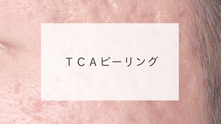 ＴＣＡピーリング