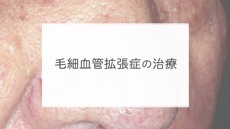 毛細血管拡張症の治療