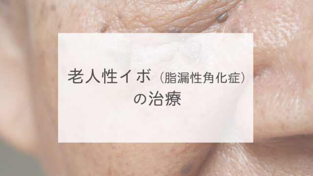 老人性イボ（脂漏性角化症）の治療