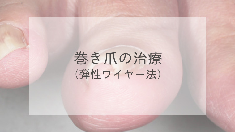 巻き爪の治療（弾性ワイヤー法）
