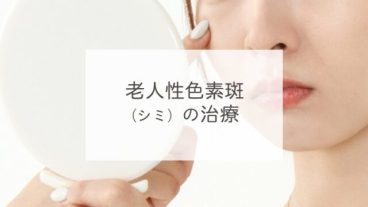 老人性色素斑（シミ）の治療