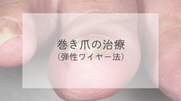 巻き爪の治療（弾性ワイヤー法）