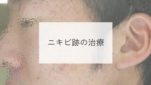 ニキビ跡の治療