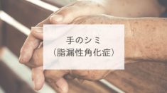手のシミ（脂漏性角化症）