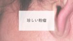 珍しい粉瘤