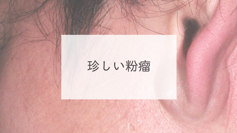 珍しい粉瘤