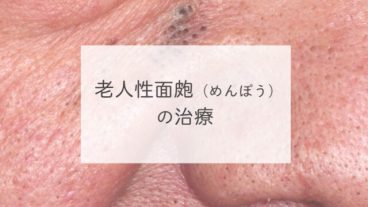老人性面皰（めんぽう）の治療