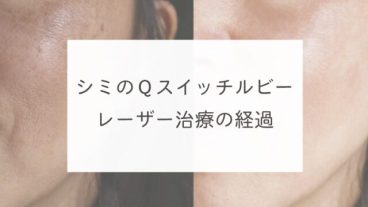 シミのＱスイッチルビーレーザー治療の経過