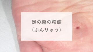 足の裏の粉瘤