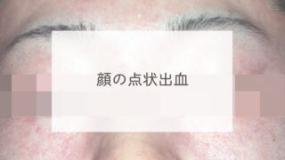 顔の点状出血