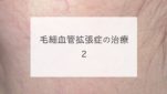 毛細血管拡張症の治療　２
