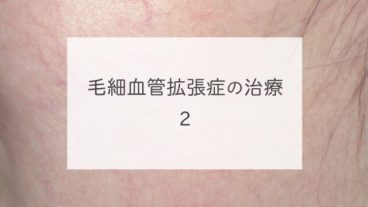 毛細血管拡張症の治療　２