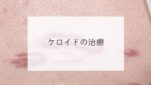 ケロイドの治療