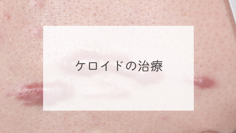 ケロイドの治療