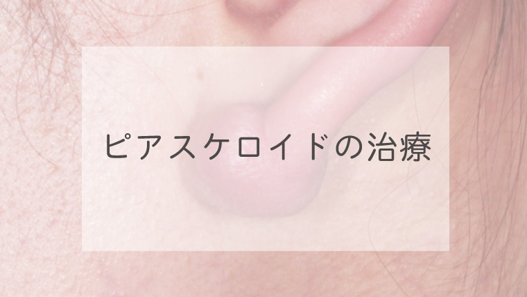 ピアスケロイドの治療