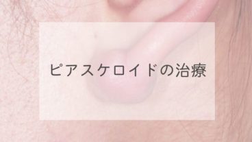 ピアスケロイドの治療