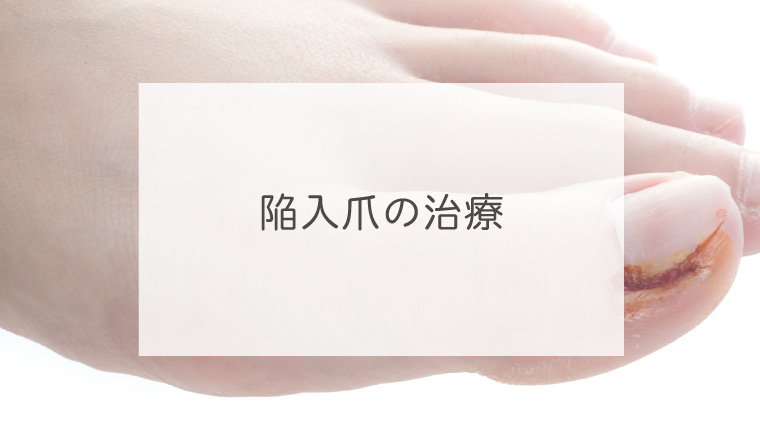 陥入爪の治療