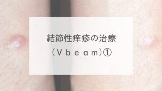 結節性痒疹の治療（Ｖｂｅａｍ）①