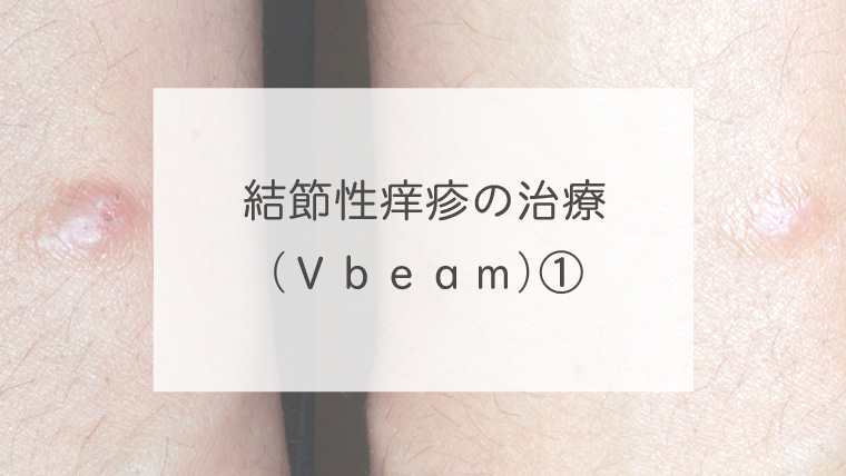 結節性痒疹の治療（Ｖｂｅａｍ）①