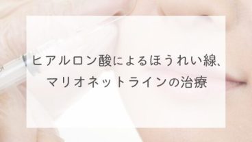 ヒアルロン酸によるほうれい線、マリオネットラインの治療