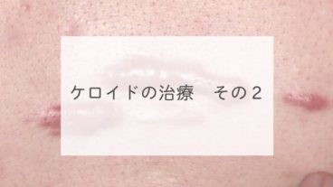 ケロイドの治療　その２