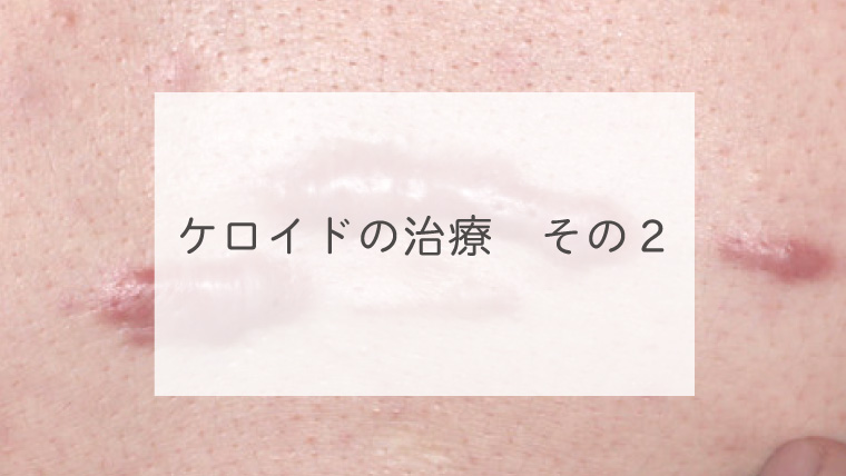 ケロイドの治療　その２