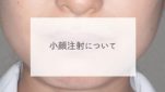 小顔注射について