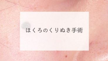 ほくろのくりぬき手術