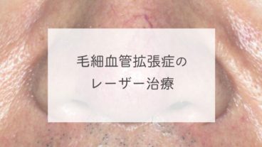 毛細血管拡張症のレーザー治療
