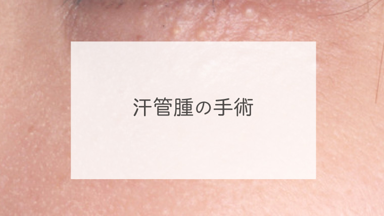 汗管腫の手術