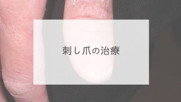刺し爪の治療