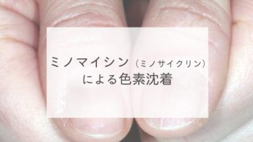 ミノマイシン（ミノサイクリン）による色素沈着