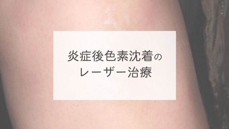 炎症後色素沈着のレーザー治療