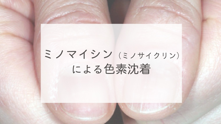 ミノマイシン（ミノサイクリン）による色素沈着