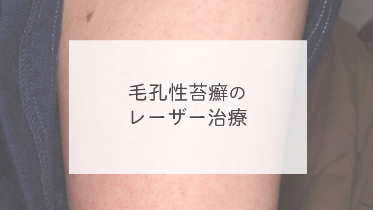 毛孔性苔癬のレーザー治療