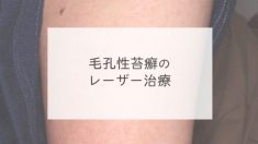 毛孔性苔癬のレーザー治療
