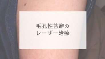 毛孔性苔癬のレーザー治療