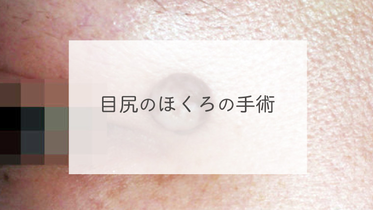 目尻のほくろの手術