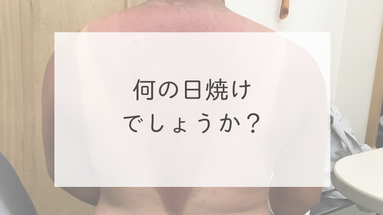 何の日焼けでしょうか？