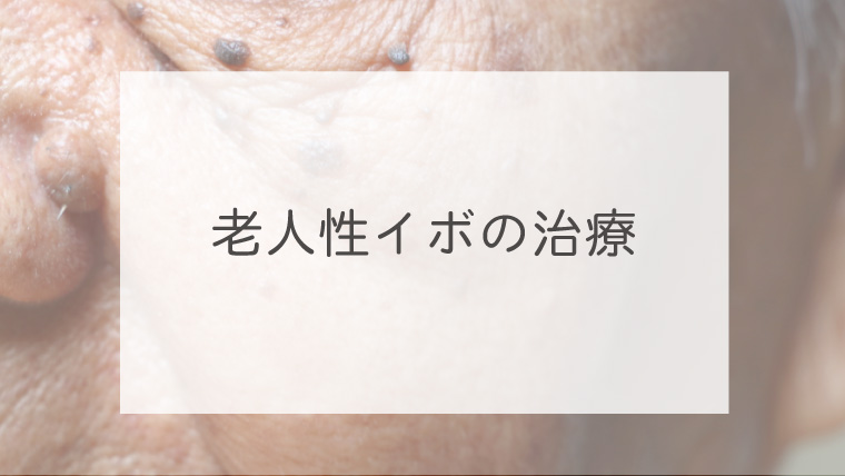 老人性イボの治療