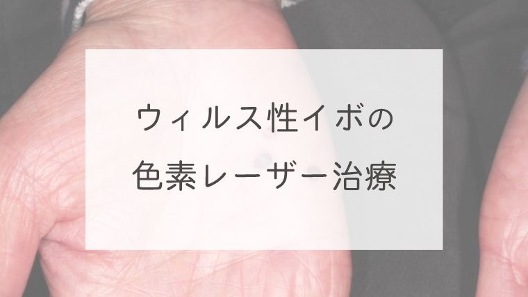 ウィルス性イボの色素レーザー治療
