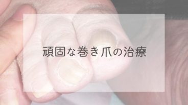 頑固な巻き爪の治療