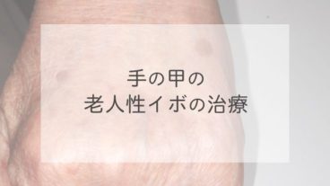 手の甲の老人性イボの治療