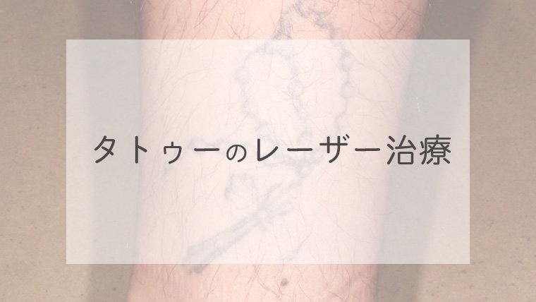 タトゥーのレーザー治療