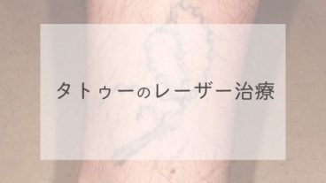タトゥーのレーザー治療