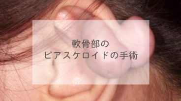 軟骨部のピアスケロイドの手術