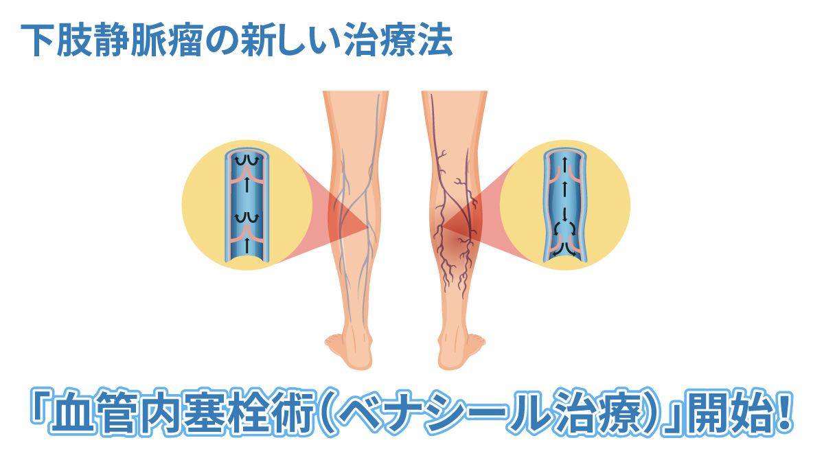 「血管内塞栓術（ベナシール治療）」開始！