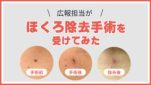 広報担当がほくろ除去手術を受けてみた