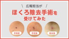 広報担当がほくろ除去手術を受けてみた